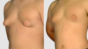 ما-هو-التثدي-عند-الرجال-gynecomastia-وطرق-علاجة-؟-1-1